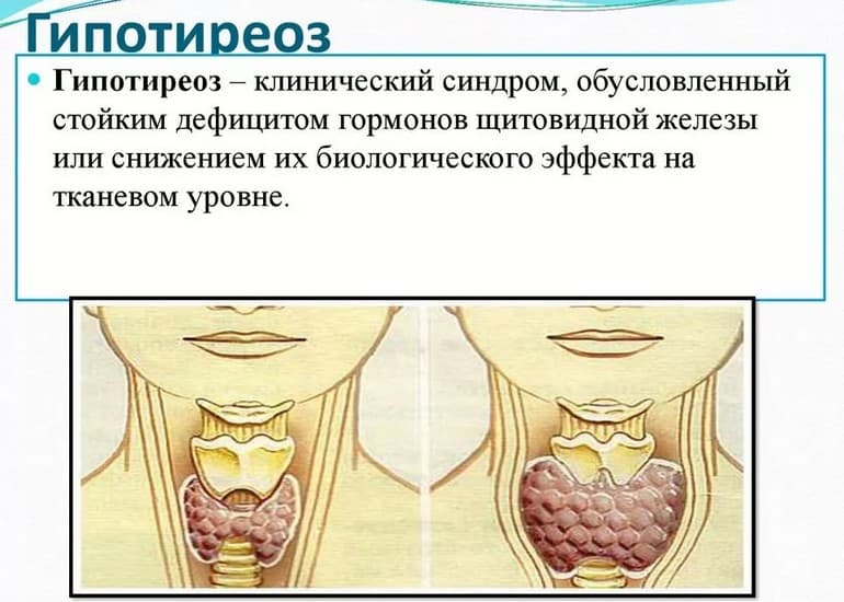 5 симптомов гипотиреоза, которые игнорируют большинствоженщин