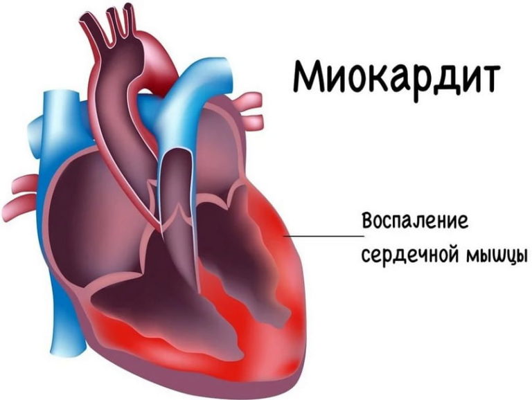 Миокардит сердца фото