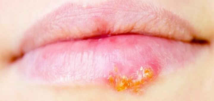 Герпес - причины, симптомы и лечение