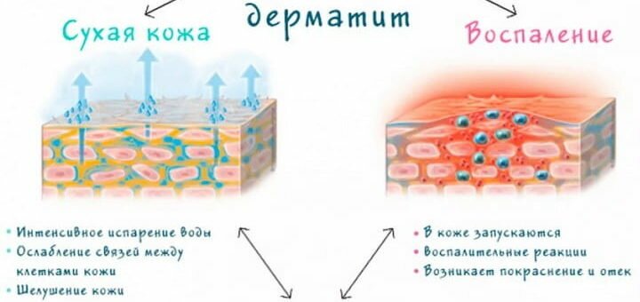 Атопический дерматит у взрослых и детей