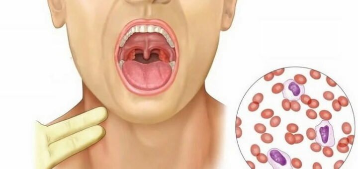 Инфекционный мононуклеоз - симптомы и лечение