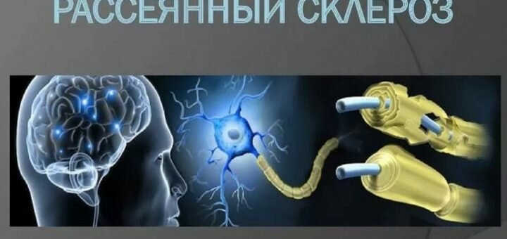 Рассеянный склероз – симптомы, причины и лечение