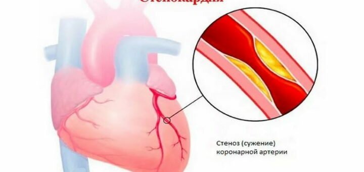 Стенокардия - симптомы и лечение