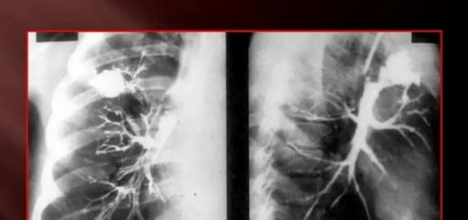 Киста легкого