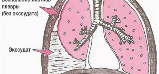 Плеврит легких - симптомы и лечение