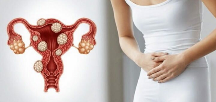 Миома матки